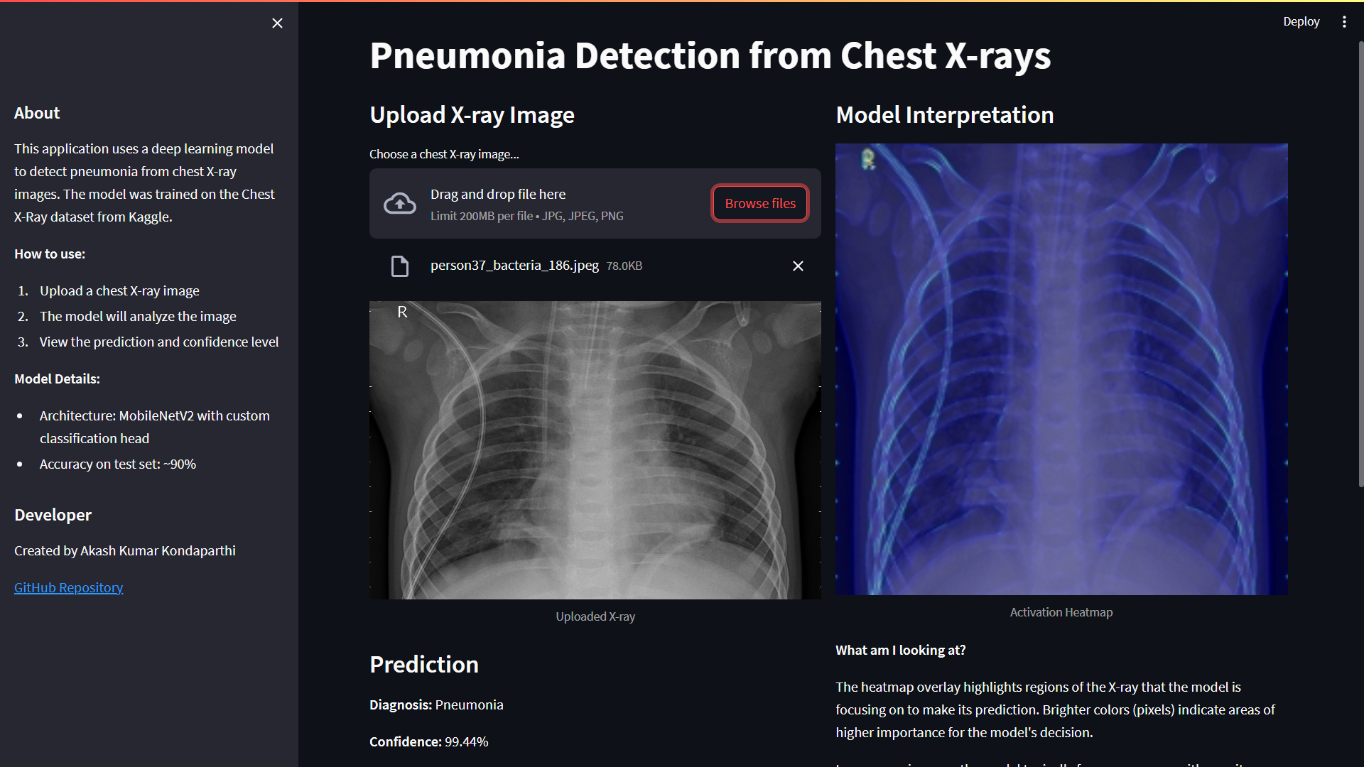 Pneumonia Detection from Chest X-rays